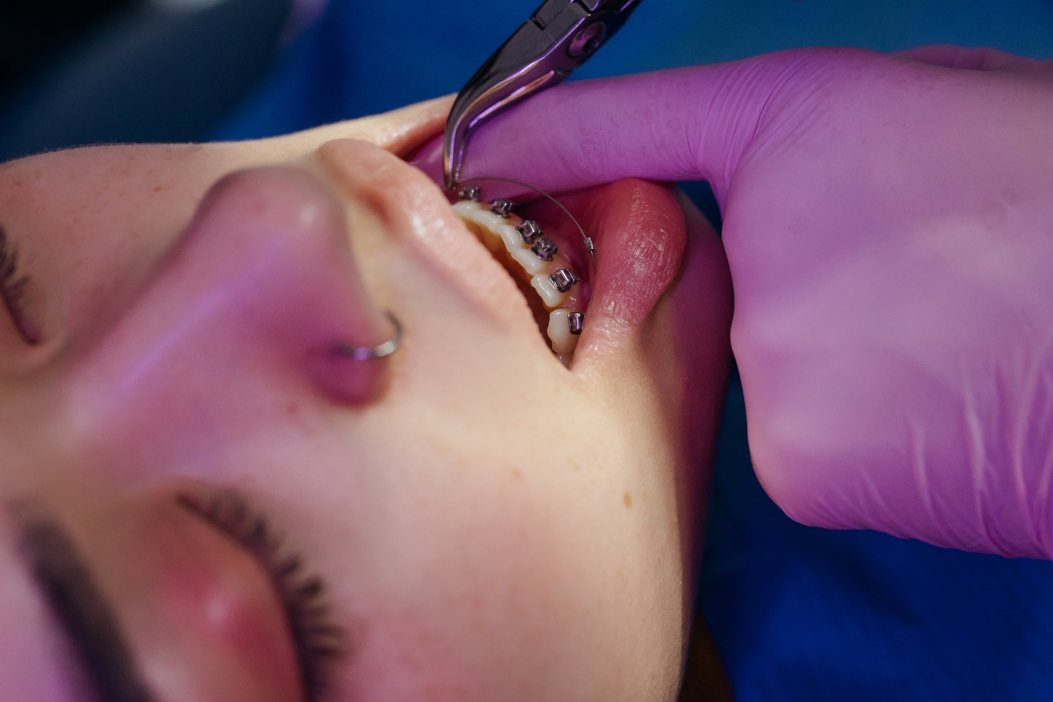 Causes of Sensitive teeth