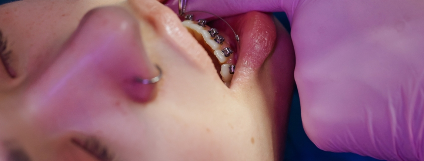 Causes of Sensitive teeth