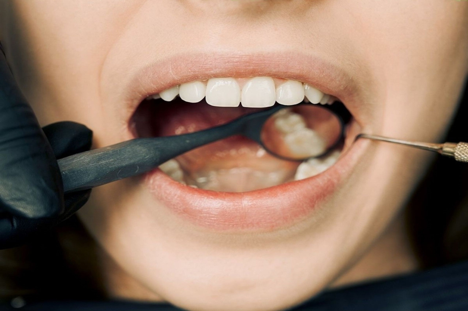 Teeth Whitening Berwick