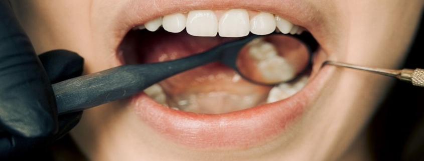 Teeth Whitening Berwick