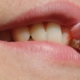 Teeth Whitening Berwick
