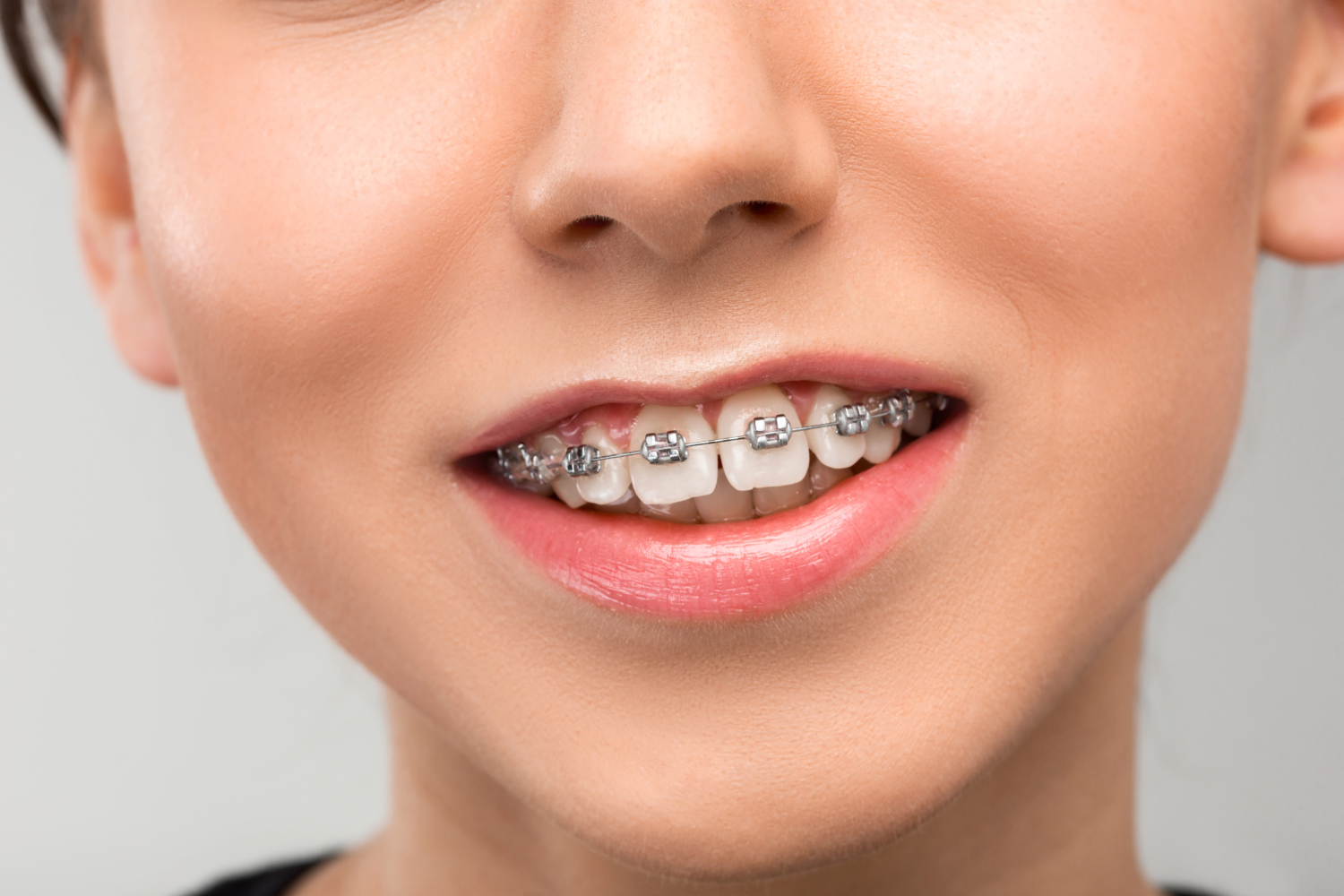 Orthodontic Braces Berwick