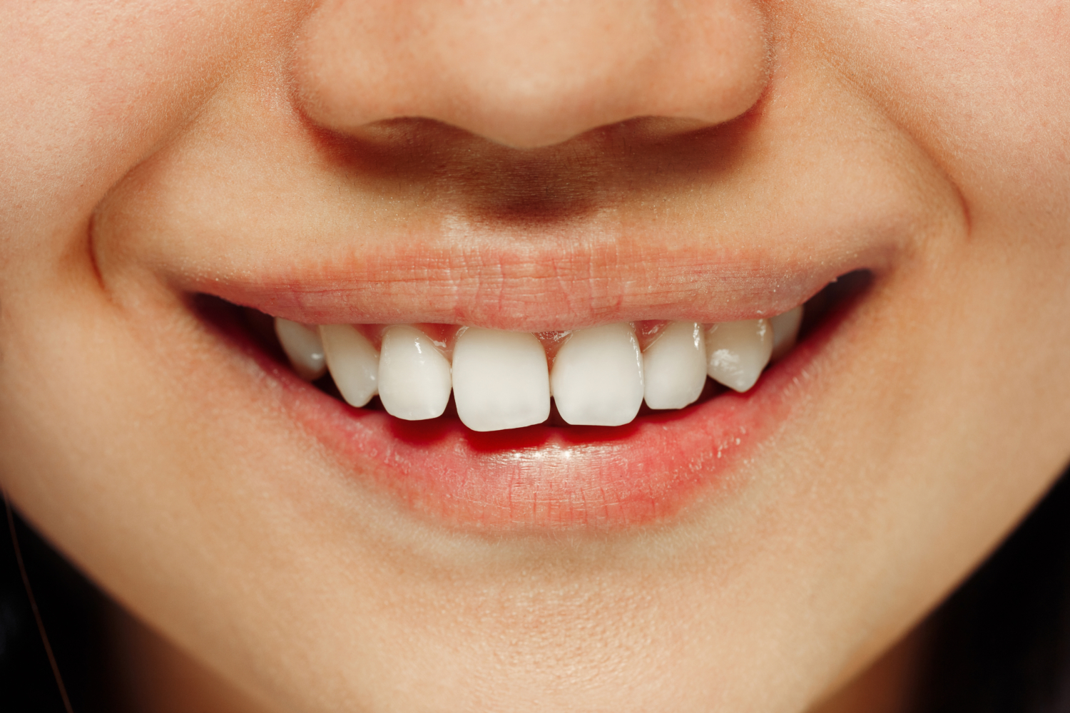 Teeth Whitening Berwick