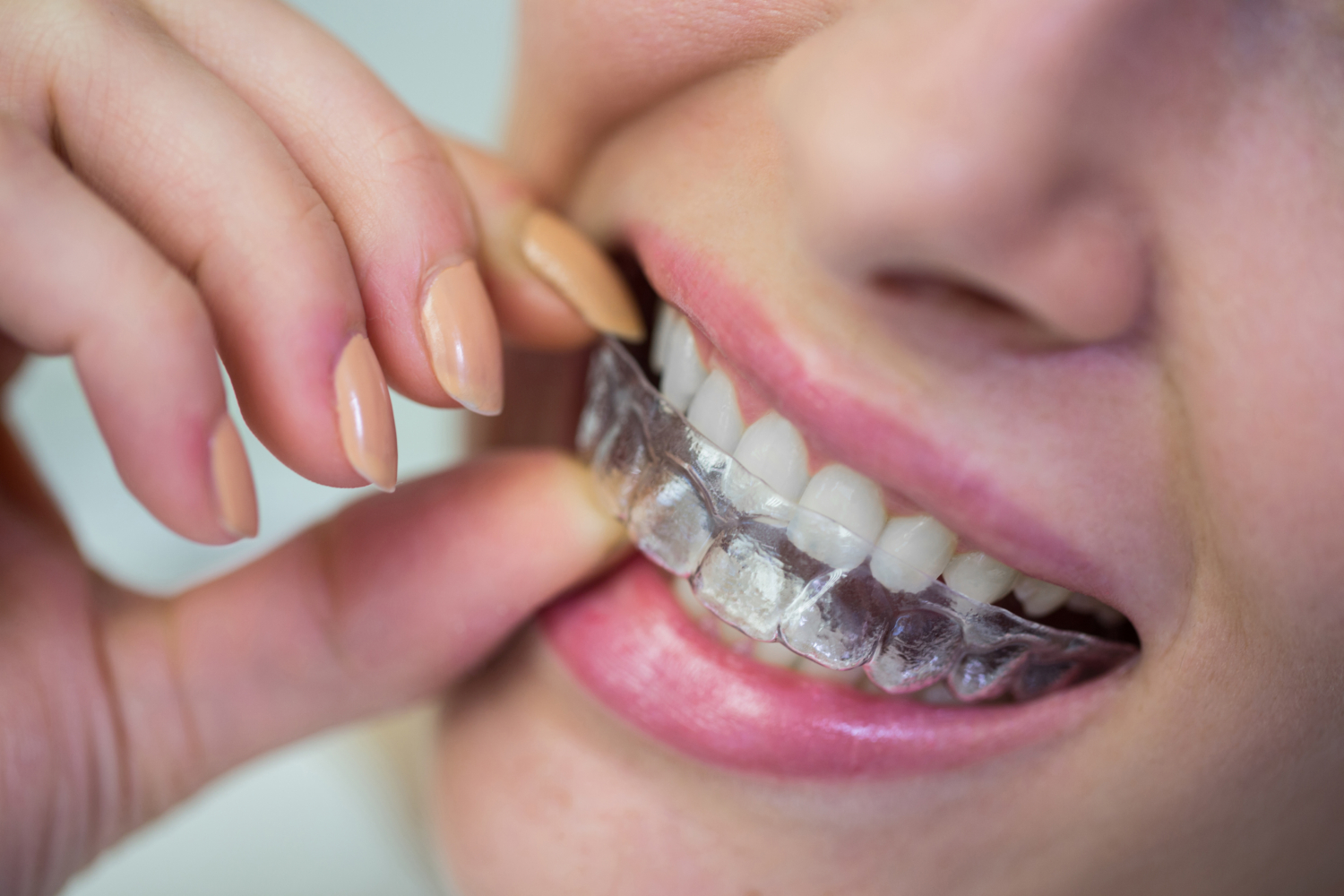 Invisalign in Berwick How Long Does Invisalign Take to Straighten Teeth?- Tweedmouth Dental Clinic
