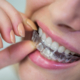 Invisalign in Berwick How Long Does Invisalign Take to Straighten Teeth?- Tweedmouth Dental Clinic