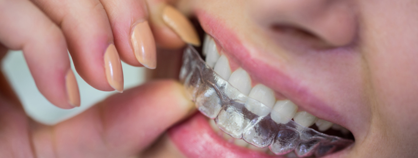 Invisalign in Berwick How Long Does Invisalign Take to Straighten Teeth?- Tweedmouth Dental Clinic
