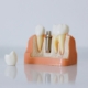 Dental Implants Berwick: Can I Drink and Eat Normally After the Procedure?- Tweedmouth Dental Clinic