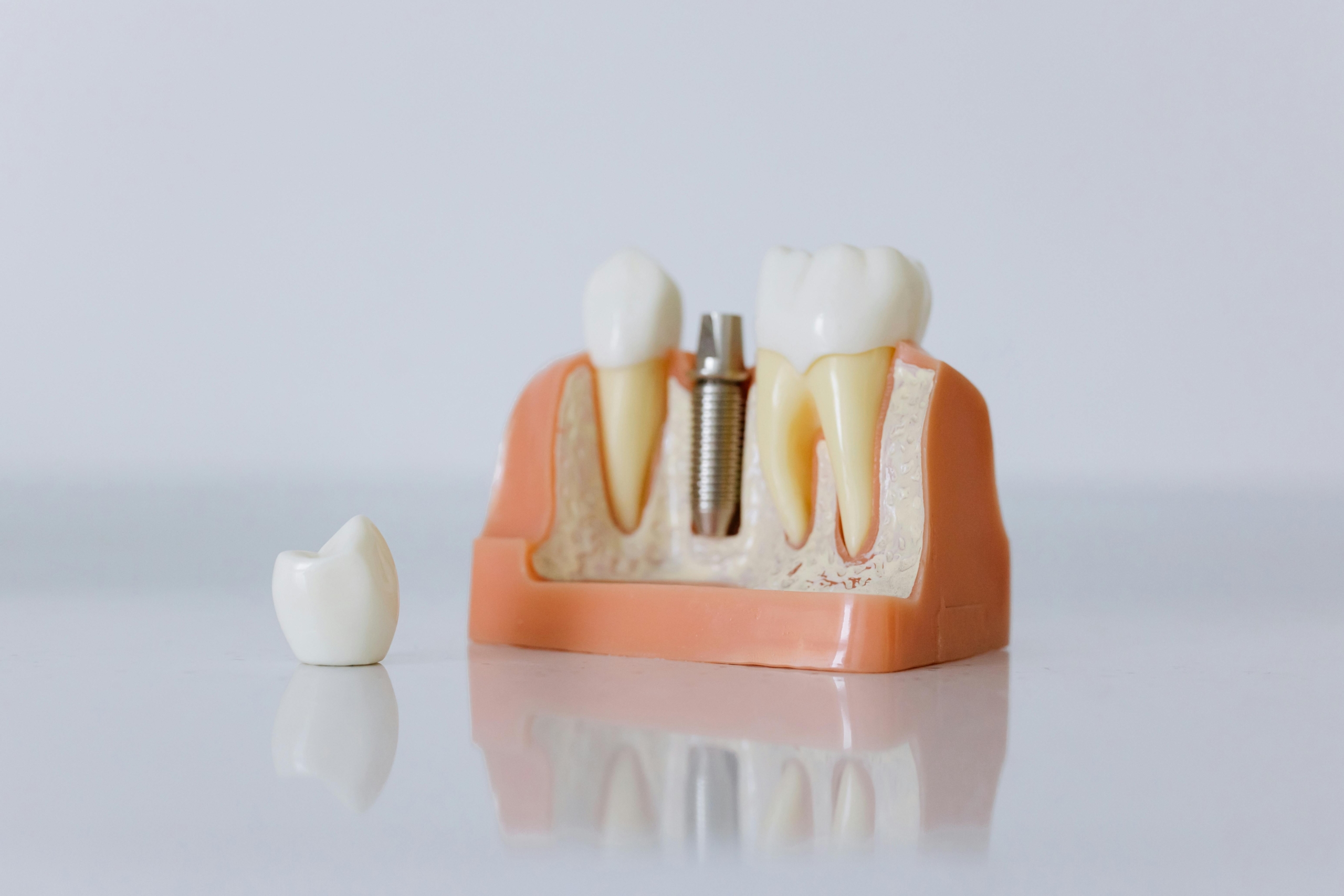 Dental Implants Berwick: Can I Drink and Eat Normally After the Procedure?- Tweedmouth Dental Clinic