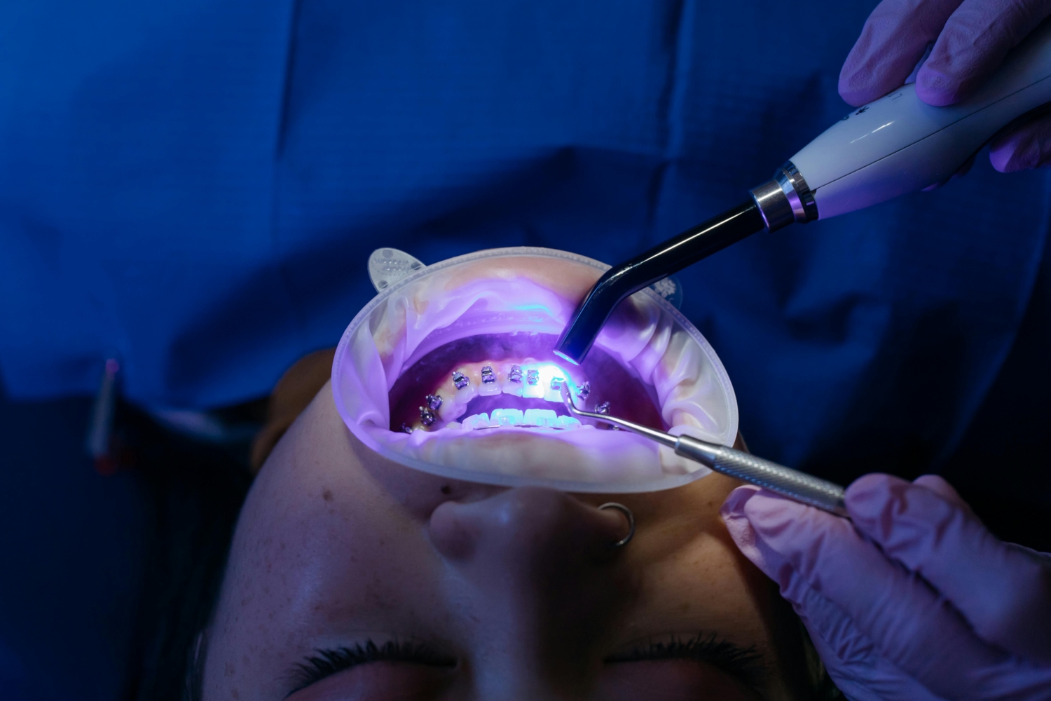 Orthodontic Braces in Berwick: What Types of Braces Are Right for Me? - Tweedmouth Dental Clinic