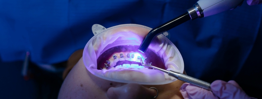 Orthodontic Braces in Berwick: What Types of Braces Are Right for Me? - Tweedmouth Dental Clinic