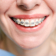 Clear Braces Berwick: How Much Time Do Clear Braces Take to Straighten Teeth? - Tweedmouth Dental Clinic