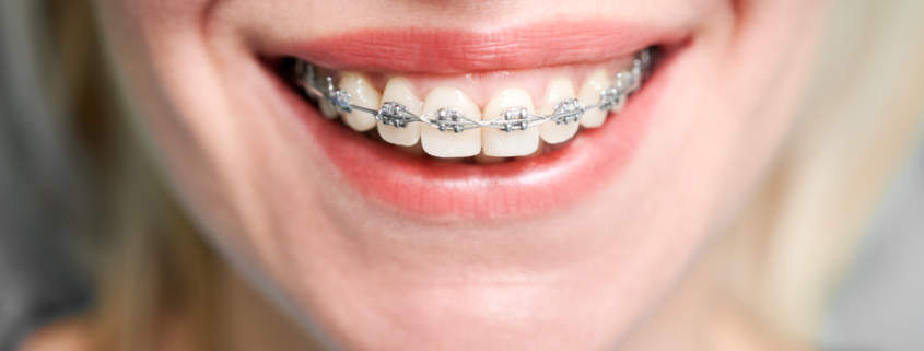 Clear Braces Berwick: How Much Time Do Clear Braces Take to Straighten Teeth? - Tweedmouth Dental Clinic